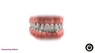 Extractions Upper 4s, Lower 5s