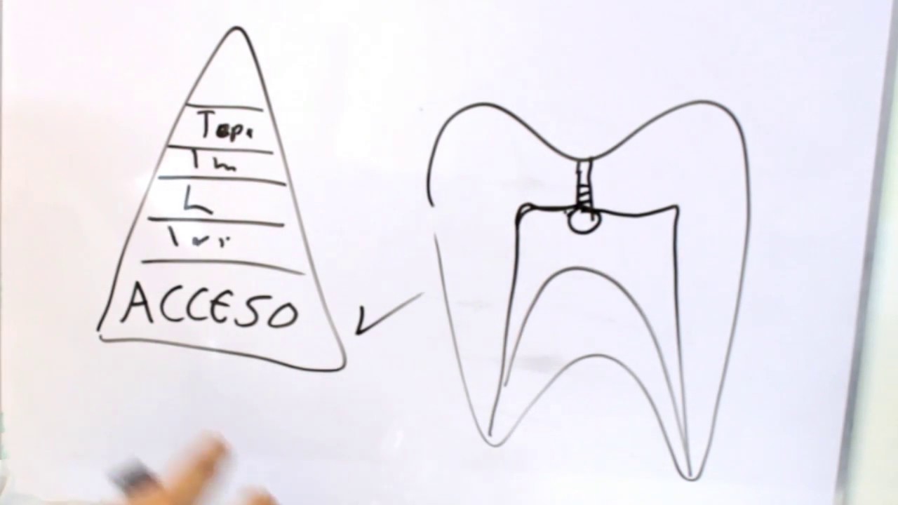 Acceso Cameral en molares Clase Muestra