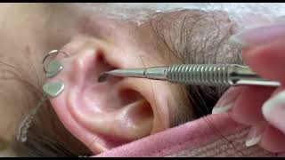 Ear cleaning. How does a beautician clean the ear