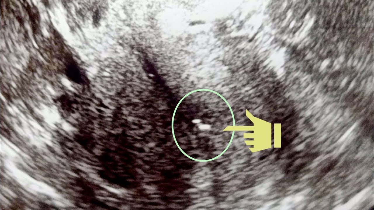 IVF Journey Update Frozen Embryo Transfer Day YouTube
