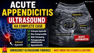 Appendix ka Ultrasound | Appendix ka Dard kyun hota | Appendicitis: Appendix ki soojan hai