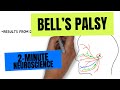 2-Minute Neuroscience: Bell&#39;s Palsy