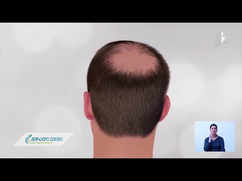 თმის ცვენასა და გაჭაღარავებასთან დაკავშირებული უჯრედები აღმოჩენილია - ახალი კვლევა