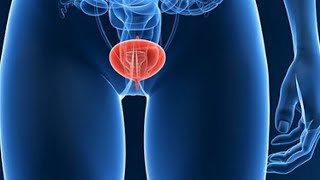 Ujue kwa undani ugonjwa wa fangasi Ukeni {Vaginal candidiasis} - Kuitambua, Kuitibu na Kuijikinga