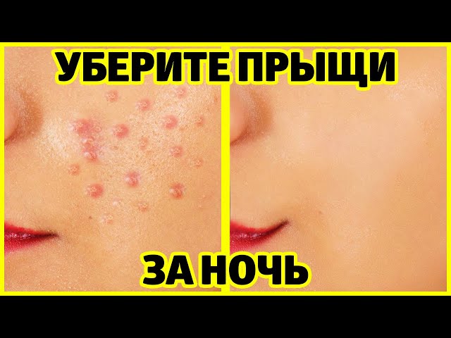 КАК УБРАТЬ ПРЫЩИ ЗА НОЧЬ - ЛУЧШИЕ РАБОЧИЕ СРЕДСТВА! - YouTube