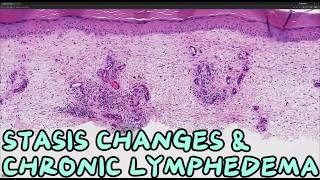 Venous Stasis Change and Chronic Lymphedema: Pathology Review