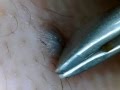 ほくろの毛を引っこ抜く!part2 Hair of a mole!