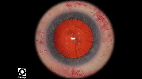 EyeSi CAT C Capsulorhexis, High Tension with Guiding Elements