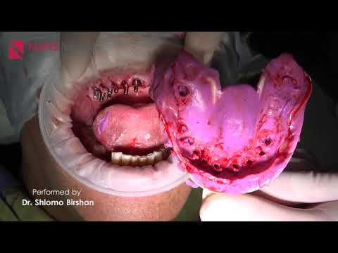 Mono Implants - Full Case | Performed by Dr  Shlomo Birshan