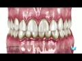 La enfermedad periodontal: Gingivitis y Periodontitis