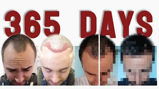 DAY 1 to DAY 365: a Picture a Day after a Hair Transplant [TIME-LAPSE]