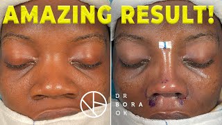 Transforming One Patient's Dream into Reality | Ethnic Rhinoplasty by Dr. Bora Ok