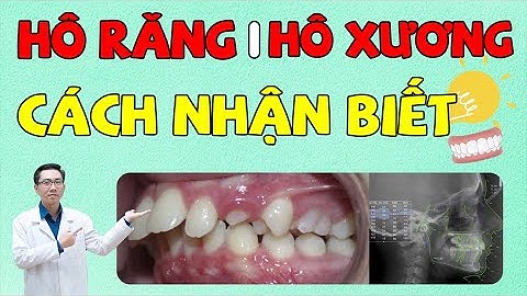 Niềng Răng | Cách Nhận Biết Hô Do Răng Hay Do Xương | Niềng Răng Hô | Nam Bùi Vinalign