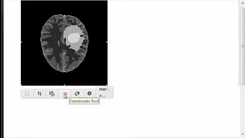 Estimation of the fractal dimension of an MRI tumor volume using 3D box counting