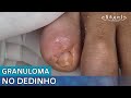 PRIMEIRO VÍDEO DE UNHA ENCRAVADA COM GRANULOMA NO DEDINHO