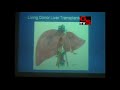 Dr hitesh chavda first liver transplantation at sterling hospital ahmedabad gs tv 2011