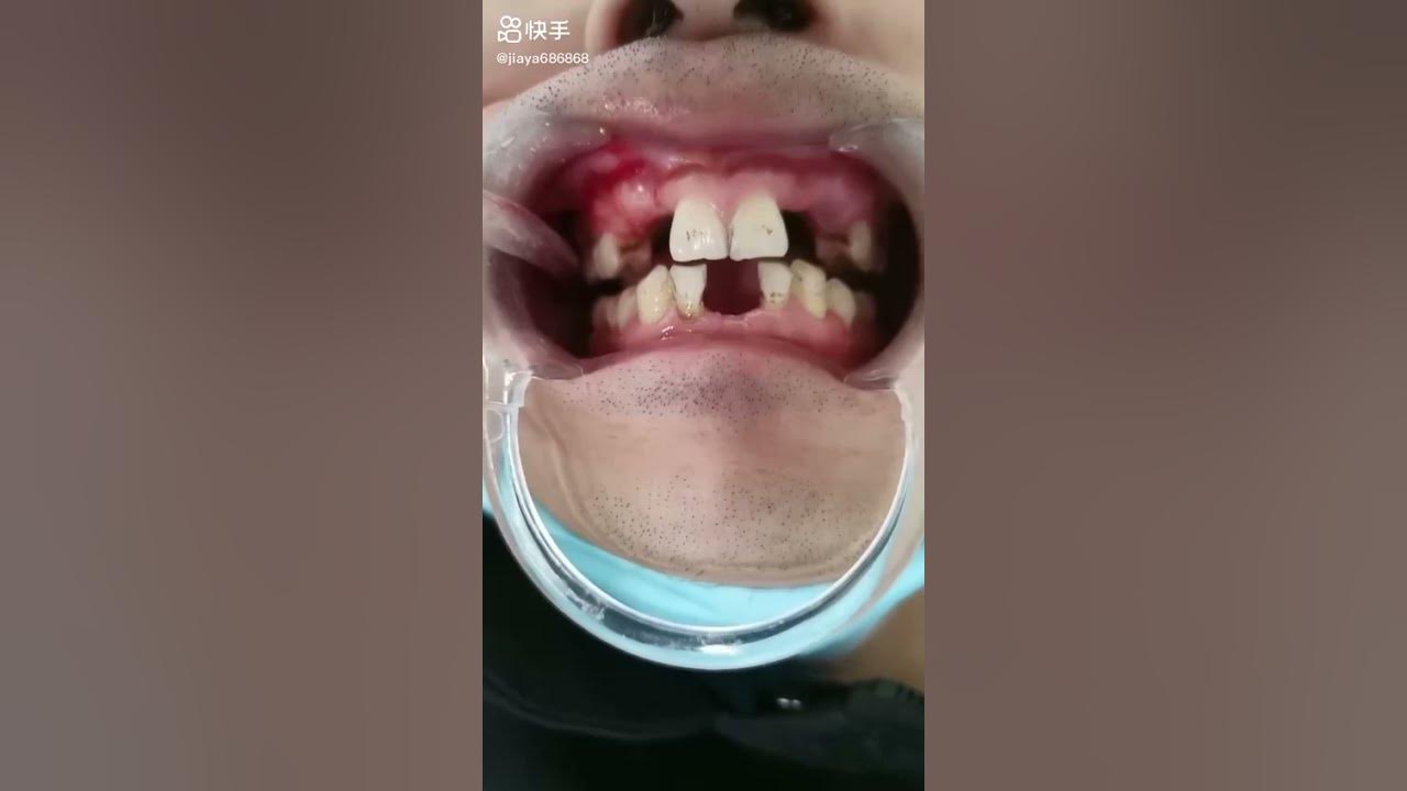 Tooth Filling Cuspid Tooth Extraction Teeth Expander Process