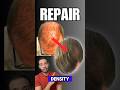 Dense Hair Transplant Repair- Dr. Munib Ahmad