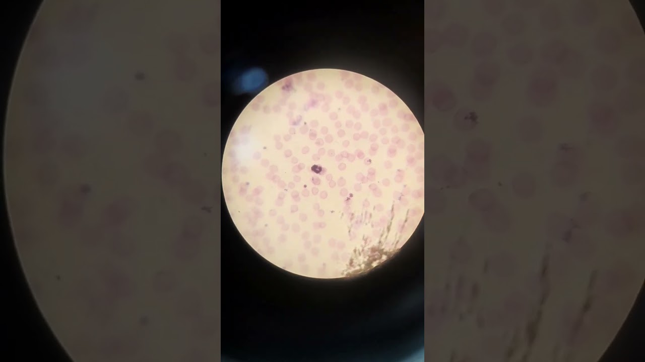 Malaria slide tell me about this slide positive or negative 