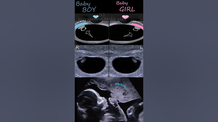 Baby boy, baby girl, RAMZI THEORY, ultrasound #baby #babygirl #shorts