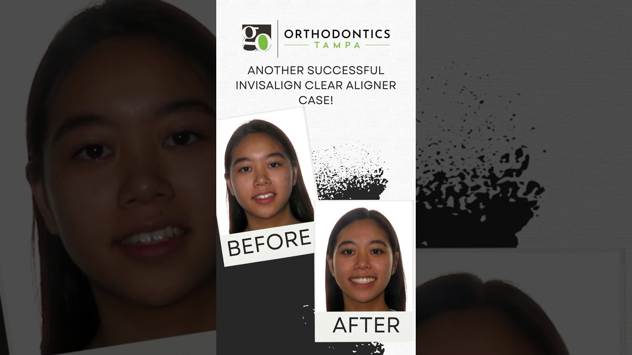 Amazing results with Invisalign for Teens in Tampa - No More Crowding! 