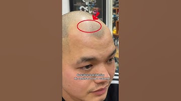 Trước & Sau Xăm Tóc – Tự Tin Hơn Chỉ Sau 1 Buổi! | Scalp Micropigmentation Transformation