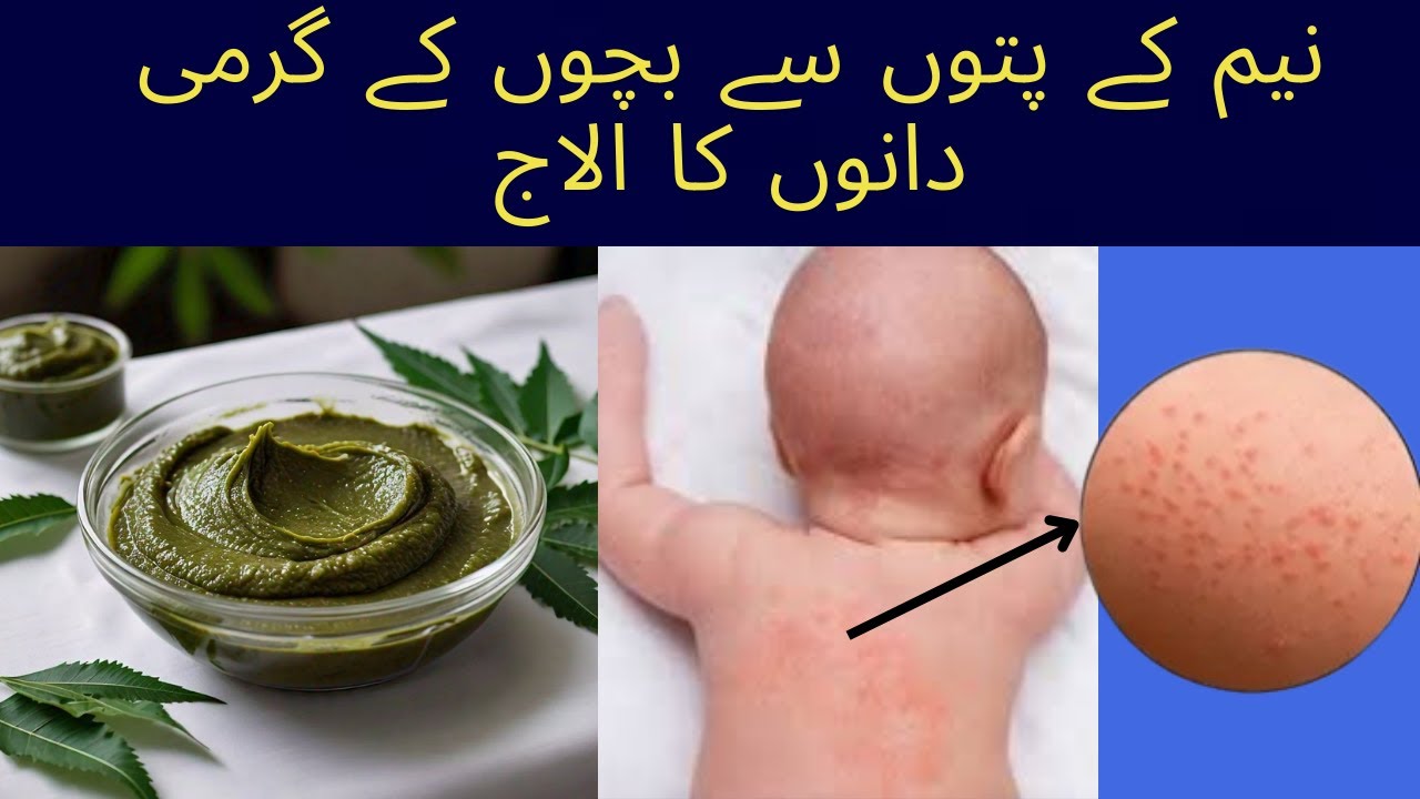 How to get rid of allergy and heat rashes with just one ingredient ...