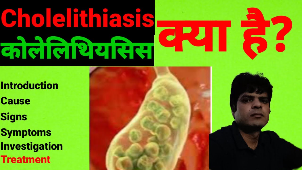 Gallbladder Stone Symptoms in Hindi Cholelithiasis in Hindi