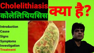 Gallbladder Stone Symptoms in Hindi - Cholelithiasis in Hindi - Gallstones - What is Cholelithiasis