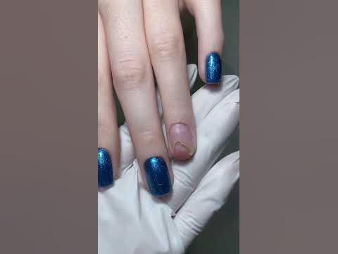 Онихолизис. плесень на ногтях - YouTube