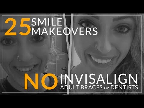 Invisalign Alternative!- No Dentist Smile Makeovers! Brighter Image Lab