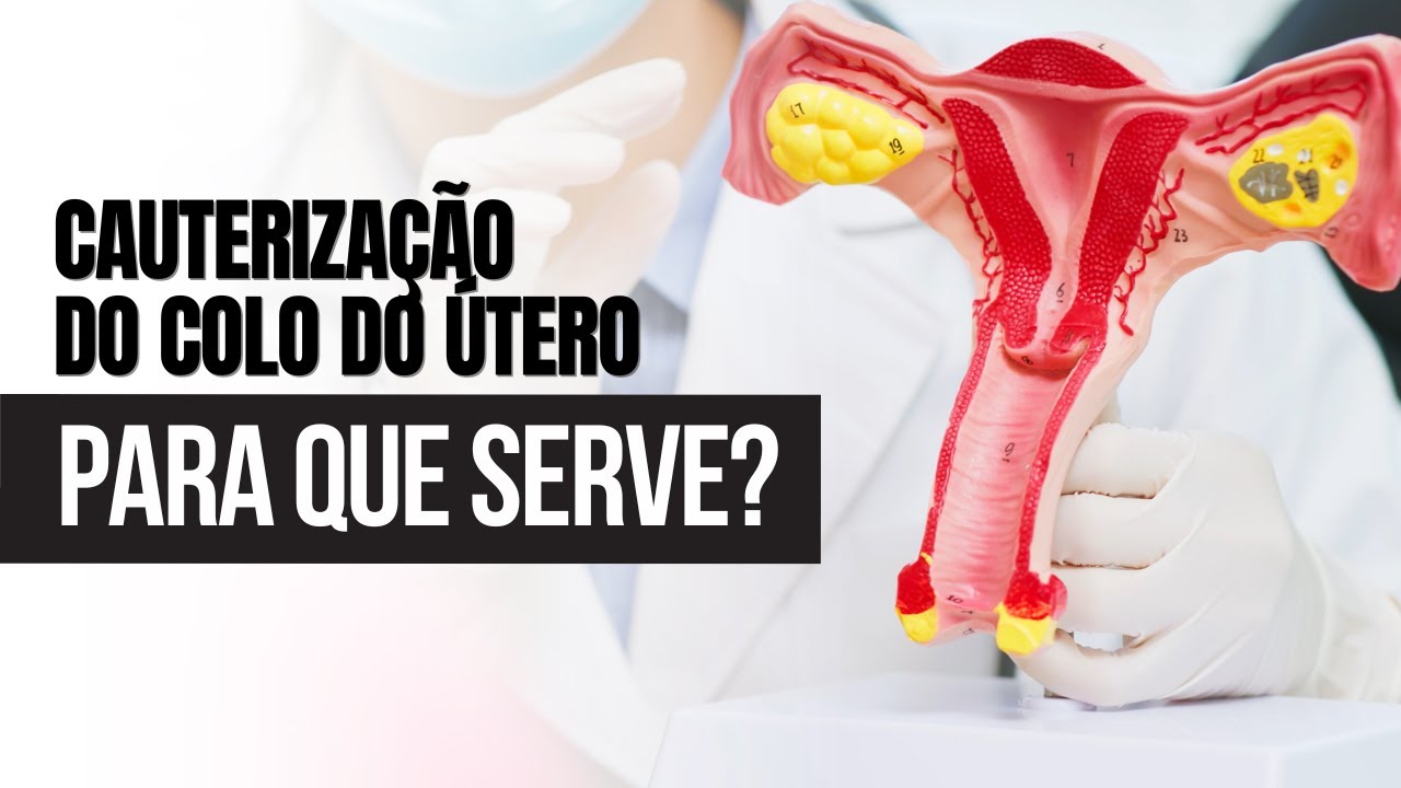 Para que serve uma cauterização no colo do útero? - YouTube