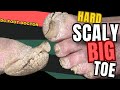 Hard scaly big toe