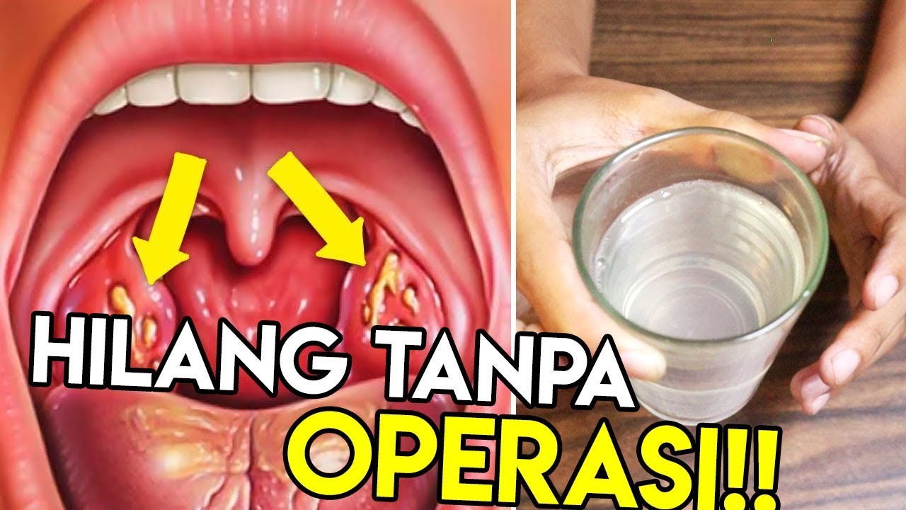 Cara Mengobati Am4ndel Dengan Bawang merah 