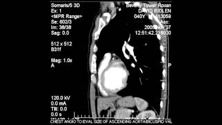 CT angiogram of my chest.