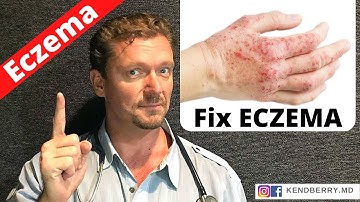 Is this Causing Your ECZEMA? (Easy Way to Tell) 2024