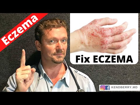 Is this Causing Your ECZEMA? (Easy Way to Tell) 2022