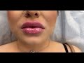 Juicy lips  lips filler  ageless md