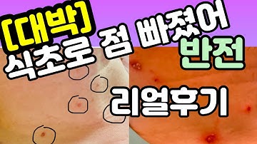 식초로 큰점 쏙!! 빠졌어요#2/ 남편 점빼기/ 중요한 관리법/ 12일차 후기 영상