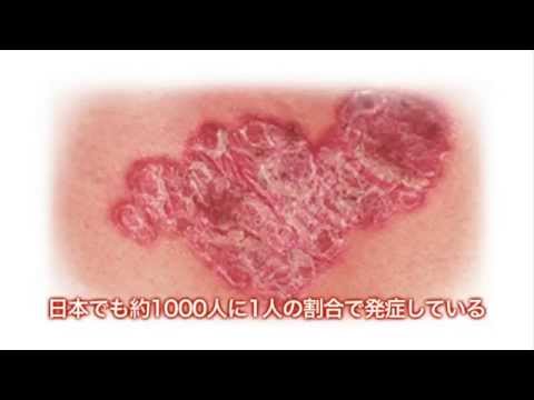 健康ぷらざ：乾せん（2014.5.18）