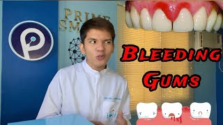 BLEEDING GUMS: Normal ba? (Gingivitis)