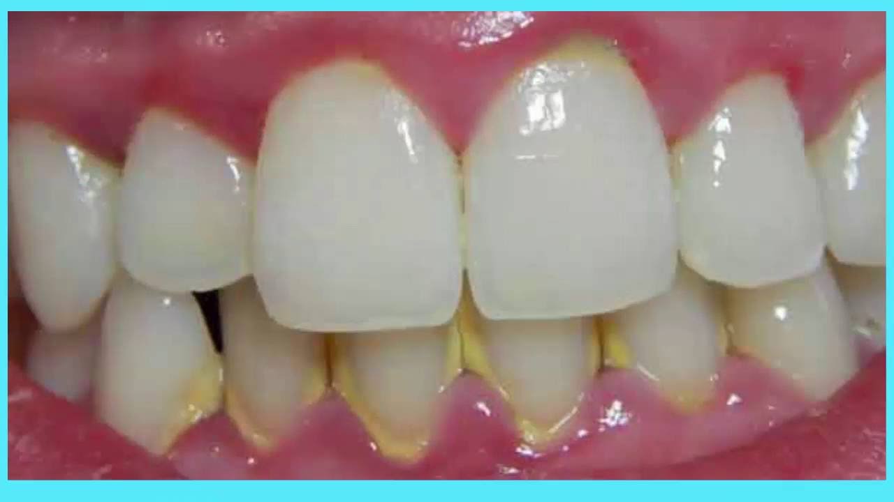 remedios naturales para la artritis Recetas caseras para eliminar el sarro de los dientes, que funcionan !!