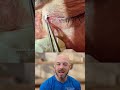 Dangers of Extraction Near the Tear Duct