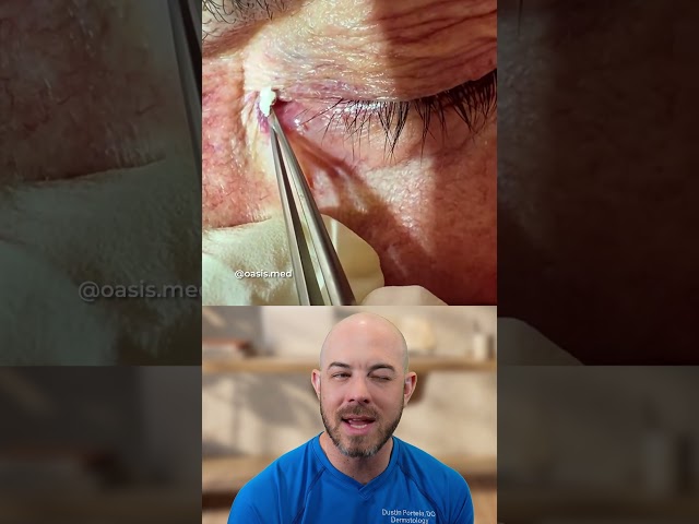 Dangers of Extraction Near the Tear Duct
