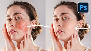 erase blotchy skin with high-end retouching trick! - photoshop tutorial