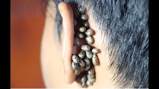 Remove insects from the ears