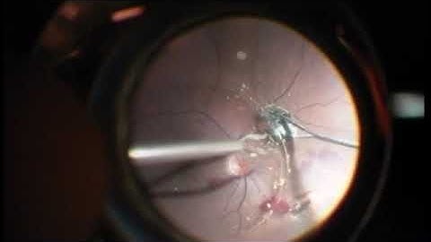 Intraocular foreign body
