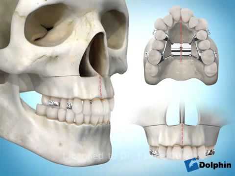 Vídeo: Um expansor quebra sua mandíbula?