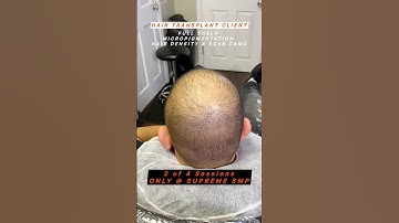 AMAZING SCALP MICROPIGMENTATION! ADJUST VIDEO TO 720P FOR HI-QUALITY RESOLUTION ​⁠@supremesmp2047