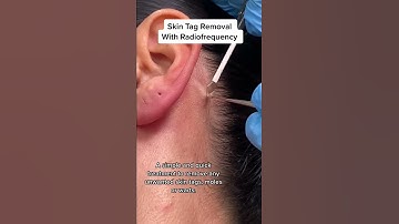 Thumbnail of Skin Tag Removal With Radiofrequency | Quick & Safe Treatment DRMEDISPA